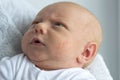 Portrait of newborn baby with manifestations of an allergy on the face Royalty Free Stock Photo