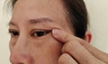 The Flabbiness adipose sagging skin beside the eyelid, wrinkles and flabby skin on the face, freckles and acne of the woman.