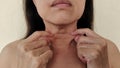 The Flabbiness adipose sagging skin under the neck, wrinkles and flabby skin under the chin, neck wattle of the woman. Royalty Free Stock Photo