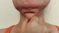 The Flabby wrinkled adipose sagging and wrinkles under the neck, cellulite under the chin.