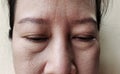 The Flabby wrinkles and ptosis beside the eyelid