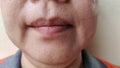 The Flabby and wrinkles beside the mouth, problem blemishes and dark spots on the face.