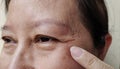The Flabby skin, wrinkles and ptosis beside the eyelid
