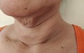 The Flabbiness adipose sagging skin under the neck, wrinkles and flabby skin on the face, freckles and dullness of the woman. Royalty Free Stock Photo