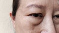 The Flabby wrinkles and ptosis beside the eyelid