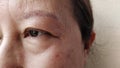 The Flabby wrinkles and ptosis beside the eyelid