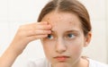 Portrait of a teenage girl touches her face with pimples, acne on the skin