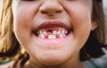 Portrait of toothless child girl missing milk and permanent teeth. Royalty Free Stock Photo