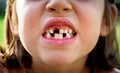 Portrait of toothless child girl missing milk and permanent teeth Royalty Free Stock Photo