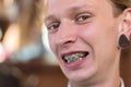 Portrait of a twenty five year old guy with braces on his teeth, smiling. Wrong bite in a young smiling guy. Dental pathology,