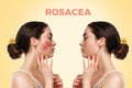 Before and after. Portrait of a young woman with rosacea on her cheek, side view. Beige background. Side view. Concept of rosacea