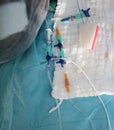 Ports of an intravenous catheter at the head of the patient`s be Royalty Free Stock Photo