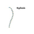 The position of the spine with kyphosis. Spinal curvature, kyphosis, lordosis, scoliosis, arthrosis. Improper posture