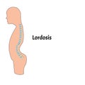 The position of the spine with lordosis. Spinal curvature, kyphosis, lordosis, scoliosis, arthrosis. Improper posture
