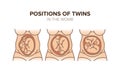 Position of twins in the womb. Pregnancy Royalty Free Stock Photo