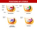 Positions of uterus