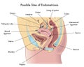 Possible sites of endometriosis