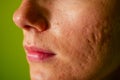 Post-acne, scars and red festering pimples on the face of a young woman. concept of skin problems and harmonic failure Royalty Free Stock Photo