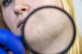 Post-acne under a magnifying glass. Skin with acne scars. Woman at the appointment with a dermatologist Royalty Free Stock Photo