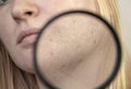 Post-acne under a magnifying glass. Skin with acne scars. Woman at the appointment with a dermatologist Royalty Free Stock Photo