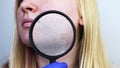 Post-acne under a magnifying glass. Skin with acne scars. Woman at the appointment with a dermatologist