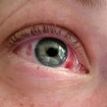 Post LASIK temporary eye hemorrhage