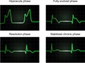 Post miocardial infarction phases Royalty Free Stock Photo