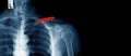 Post operation of clavicle fracture and fixed Royalty Free Stock Photo