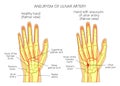 Post-traumatic ulnar artery aneurysm located adjacent to the hamate bone