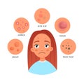 Acne infographics. Royalty Free Stock Photo