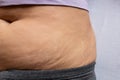 Postnatal changes as stretches on skin. After birth marks on belly of woman. Close-up view of postpartum stretches or age skin