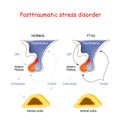 Posttraumatic stress disorder