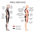 Kyphotic lordotic posture. The side view shows deformation of rounded shoulders and hyperlordosis, pelvis rotation, stretched and