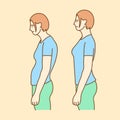 People with impaired posture position defect scoliosis and ideal bearing