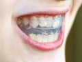 Pre-orthodontic trainer for bite close up