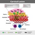 A precancerous cervical lesion. Abnormal cervical appearance. Medical vector illustration