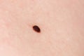 Precancerous mole - birthmark is potentially cancerous melanoma