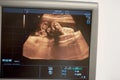 Pregnancy sonogram x-ray on a monitor of ultrasound scanner