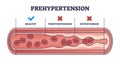 Prehypertension, healthy and hypertension blood comparison outline diagram Royalty Free Stock Photo