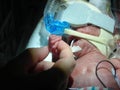 Premature Baby in NICU