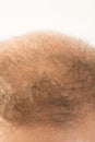 Premature baldness, man, 40s, white background