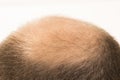 Premature baldness, man, 40s, white background