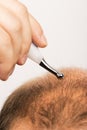 Premature baldness, man, 40s, white background