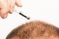 Premature baldness, man, 40s, white background