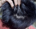 Prematurely gray hair. Southeast Asian young man showing his early grey hair.