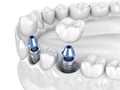 Premolar and Molar tooth crown installation over implant - white concept. 3D illustration of human teeth and dentures