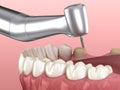 Premolar preparation process for dental crown placement. Medically accurate illustration