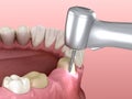 Premolar preparation process for dental crown placement. Medically accurate 3D illustration