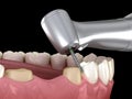 Premolar preparation process for dental crown placement. Medically accurate 3D illustration Royalty Free Stock Photo