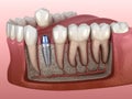 Premolar tooth crown installation over implant abutment. Medically accurate 3D illustration of human teeth and dentures